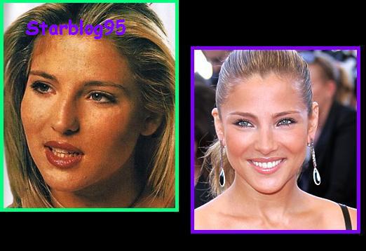 elsa pataki - chirurgie - avant/après !